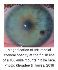 Corneal Edema... a.k.a. "Ultra Eye"... — Tri2Max Coaching LLC