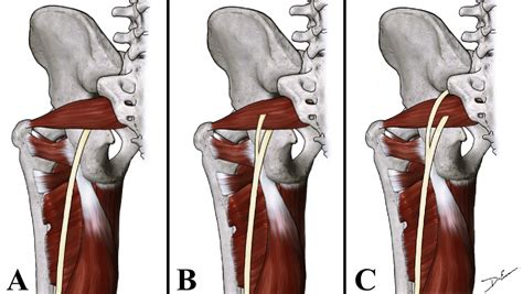 Figure 1 from Anatomical Variations of the Sciatic Nerve Exit from the ...