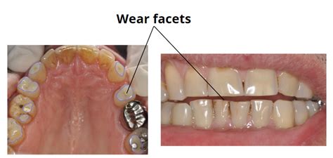 How do wear facets occur, and how to deal with them?