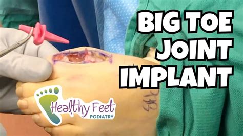 Big Toe Joint Implant for Pain and Arthritis - YouTube