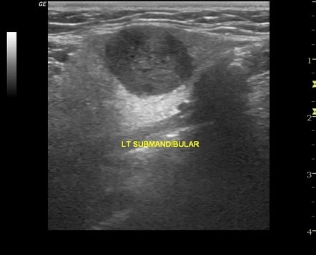 Submandibular Gland Ultrasound