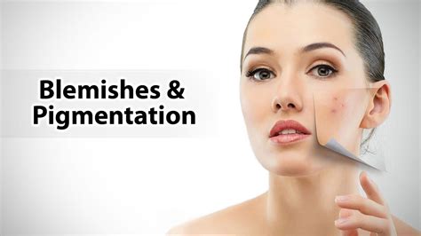 Blemishes & Pigmentation - YouTube