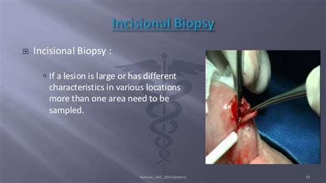 Biopsy in Oral Surgery