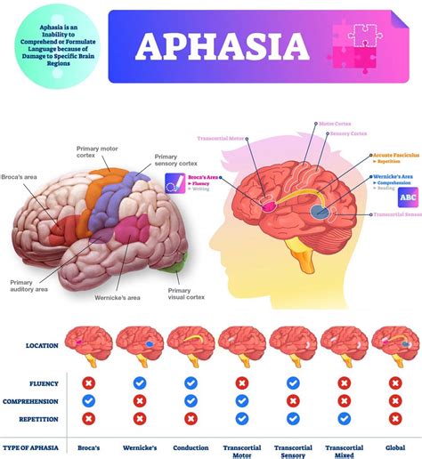 One of the main causes of aphasia is stroke - https://debuglies.com