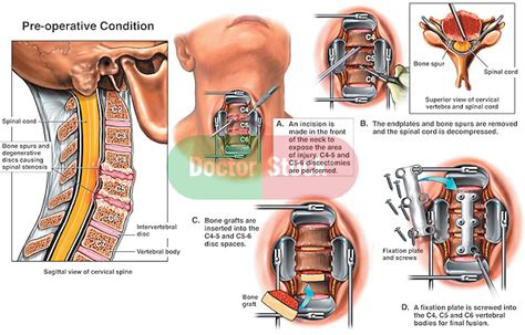 Stenosis: Stenosis Treatment