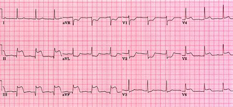 Basic EKG Interpretation, A. Olseth, St Davids - ProProfs Quiz