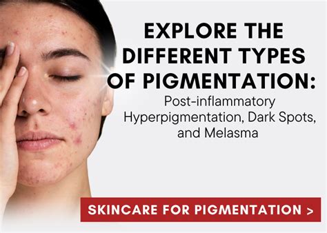 Skin pigmentation has many types?🤔 - NIHON Skin