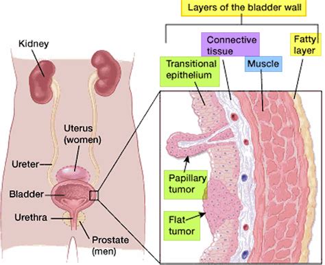 Transitional cell carcinoma causes, symptoms, diagnosis, treatment ...