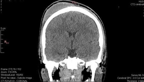 Subgaleal Hemorrhage Ct Scan In Babies