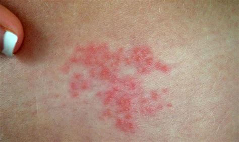 Pictures of Shingles Rash (part 2) | Shingles Expert