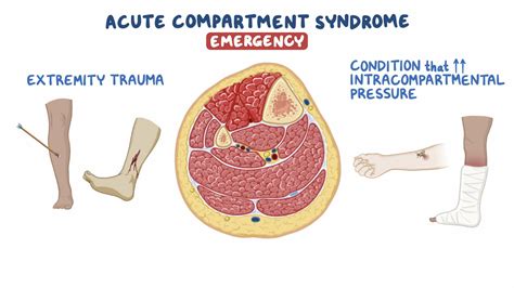 Compartment syndrome: Clinical sciences - Osmosis Video Library