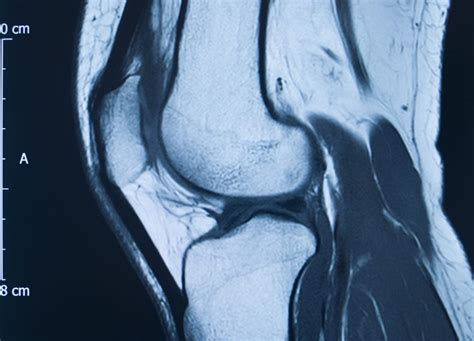 ACL Vs MCL Tears: What Is The Difference?