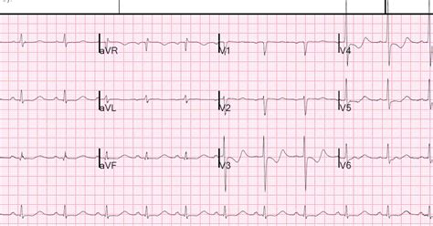 Dr. Smith's ECG Blog: Are These Wellens' Waves??