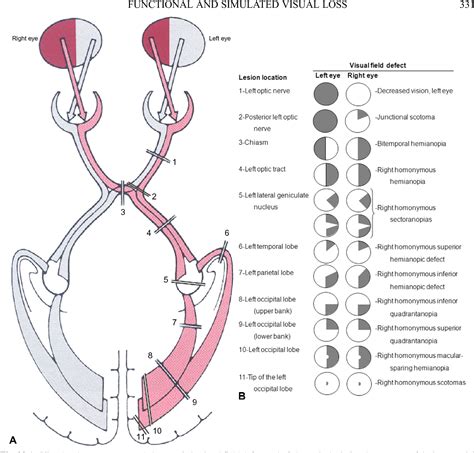 Figure 29.1 from Functional and simulated visual loss. | Semantic Scholar