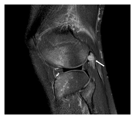 Fracture of the Fabella: A Rare Injury in Knee Trauma (PDF Download ...