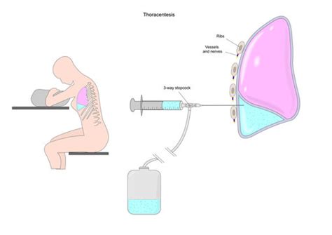 Thoracentesis Needle Size