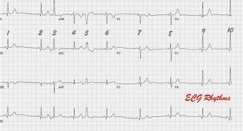 ECG Rhythms: A Unifying explanation