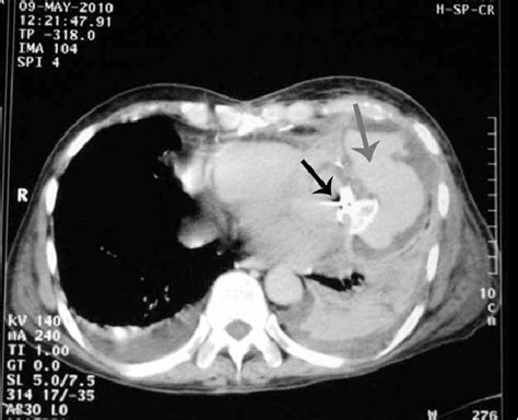 Figure1: Amplatzer Device (black arrow) is Seen at the Neck of... | Download Scientific Diagram