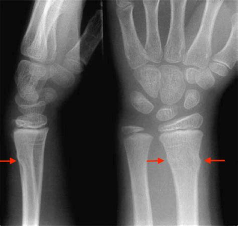 Pediatric Torus Buckle Fracture - StatPearls - NCBI Bookshelf