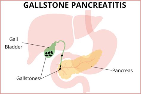 Gallstone Pancreatitis: Causes, Symptoms, & Treatment