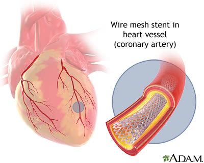 How Do They Put A Stent In Your Heart - Crawford Warrhatiou