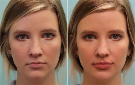 Lip Augmentation photos | Chevy Chase, MD | Patient 16303