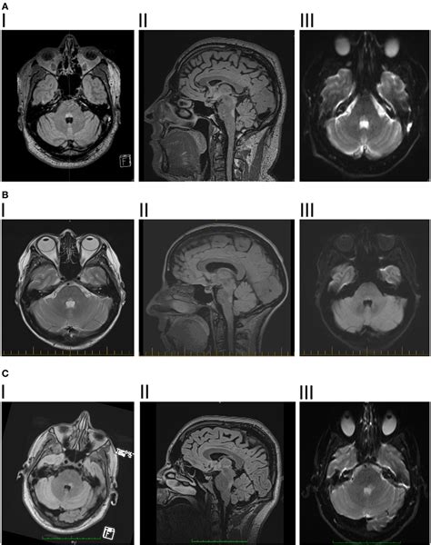 Frontiers | Isolated Horizontal Gaze Palsy: Observations and Explanations