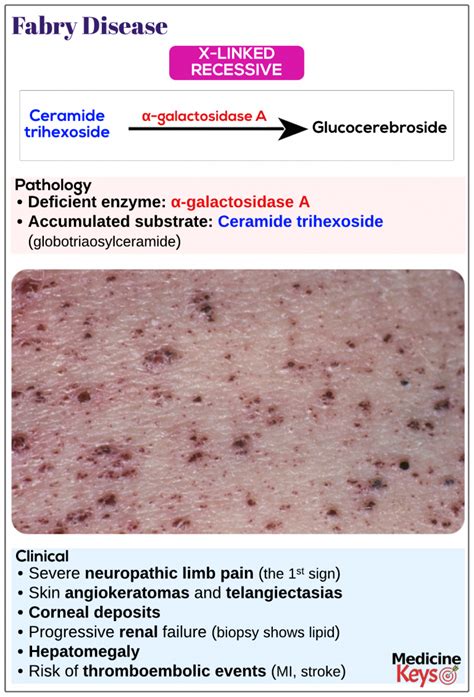 Fabry disease - Medicine Keys for MRCPs