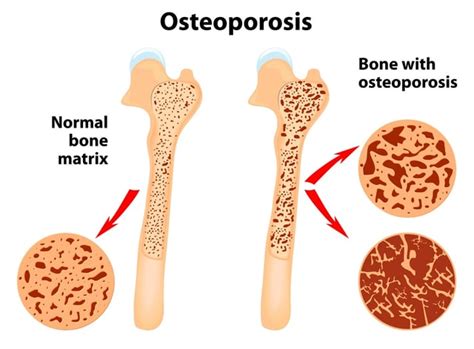 What is Osteoporosis? Signs, Symptoms, and Risks