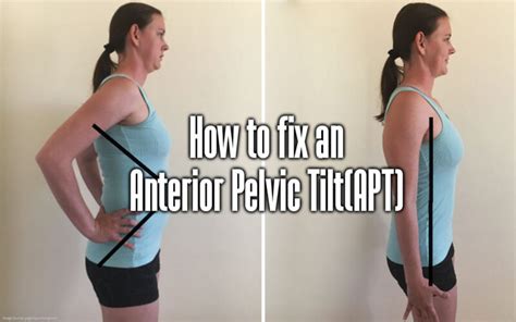 What Is Anterior Pelvic Tilt & How Do You Fix It? - Your Body Posture