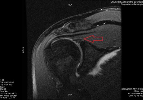 Shoulder Labrum Tear & Choosing Surgery: Personal Experience