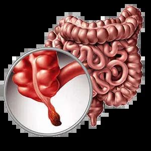 Foods & Appendix Cancer | Healthreee