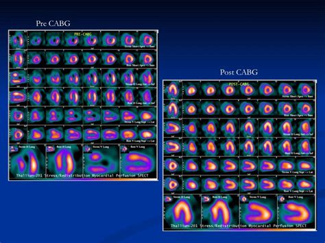 Nuclear Imaging In Cardiology Cme