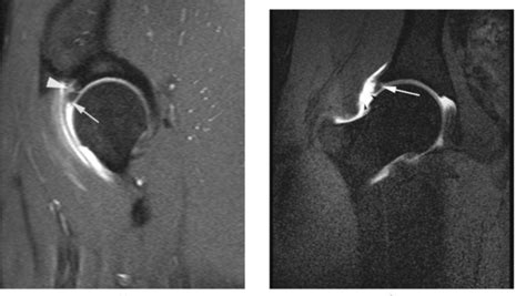 Labral Tear - Jeffrey Giuliani MD