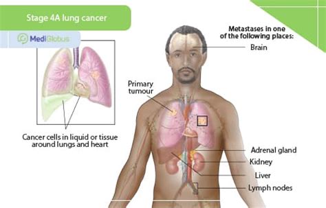 Can stage 4 lung cancer be cured? | Medical Tourism with MediGlobus: The best treatment around ...