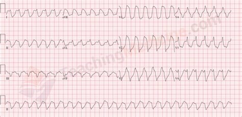 Teaching Medicine - Tutorial: Rhythm Diagnostic Criteria