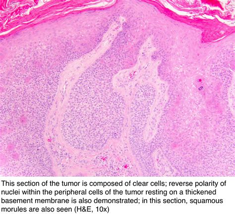 Pathology Outlines - Trichilemmoma