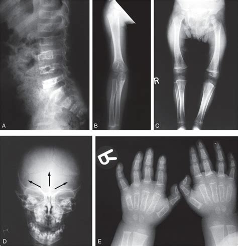 Differential diagnosis III: osteogenesis imperfecta | Radiology Key