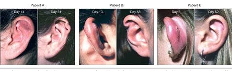 Pseudomonas Ear Infection