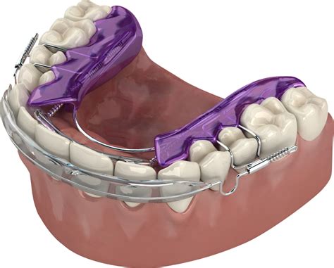 Inman Aligner™ - Kenilworth, IL - Art Carpenter, DDS, LLC