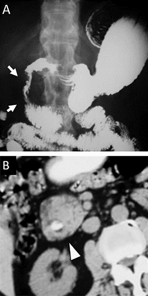 Annular Pancreas. Anteroposterior single contrast upper... | Download Scientific Diagram