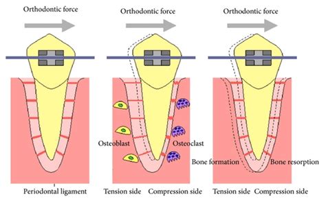 How Do Braces Work? | Orthodontic Associates