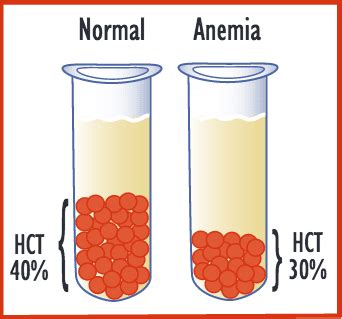 Anemia