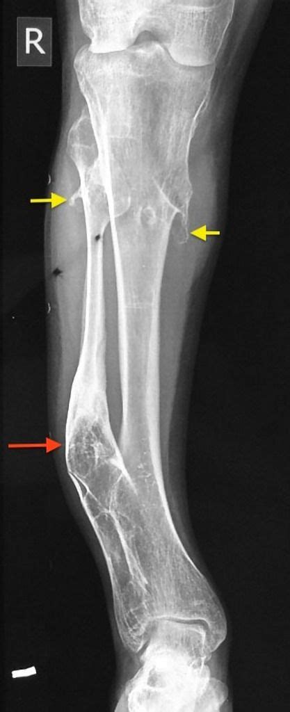 Multiple hereditary exostoses | Radiology Case | Radiopaedia.org | Radiology, Nuclear medicine ...