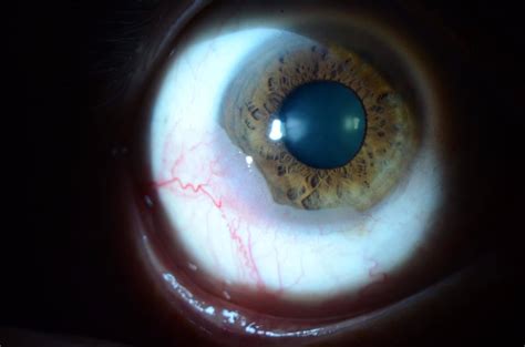 conjunctival lesion | Wills Eye Hospital