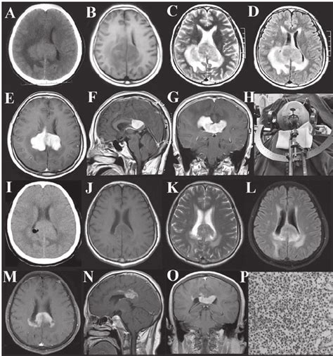 Primary central nervous system lymphoma in the splenium of the corpus... | Download Scientific ...