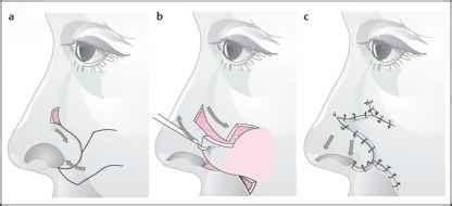 Turnover Flap and Composite Graft - Facial Plastic Surgery