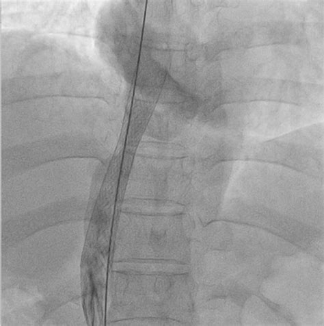 The stable Wall stent in the inferior vena cava with very good flow to... | Download Scientific ...