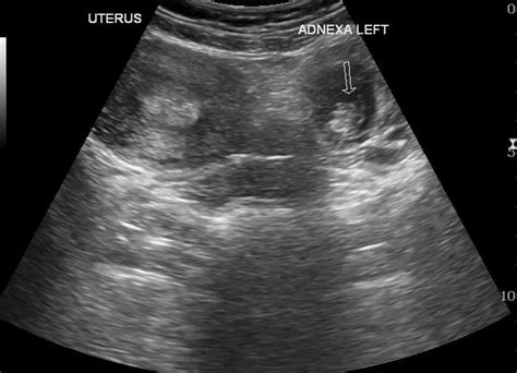 Ectopic Pregnancy – Core EM