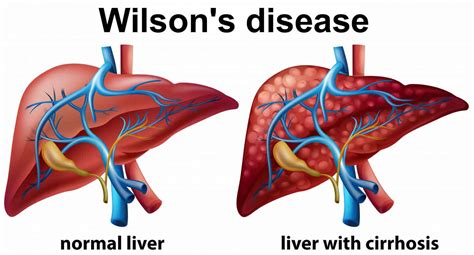 symptoms of wilson's disease Wilsons healthresource4u diseases ...